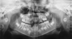Dental Radiographs (X-Rays) - Pediatric Dentist in Chicago, IL