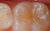 Sealant-Before - Pediatric Dentist in Chicago, IL